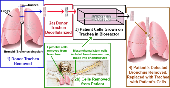 Macchiarini's Bioengineered Bronchus Replacement Caption